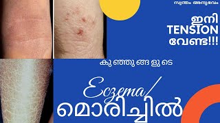 How to Cure Dry Skin in Babies/Eczema/Atopic Dermatitis in Malayalam/പെട്ടെന്ന് മാറ്റാം