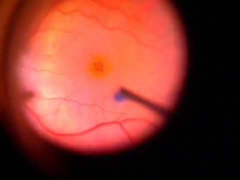 Vitrectomie pour trou maculaire