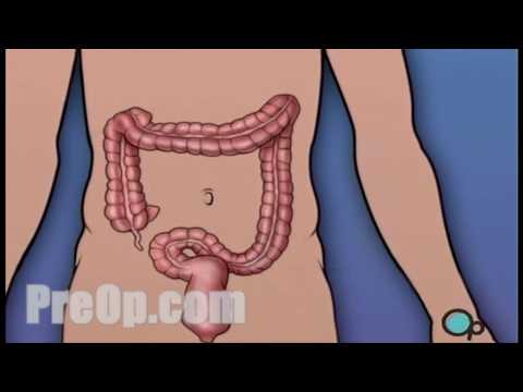 Video Endoscopy Dan Colonoscopy Adalah Video Endoscopy Dan Colonoscopy Adalah