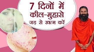 चेहरे के पिंपल्स और दाग धब्बे (Pimples and Acne) दूर करने का घरेलू उपाय | Swami Ramdev