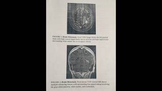 #brain #anatomy #mets#cancer