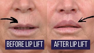 Los Angeles Upper Lip Lift Beverly Hills Lip Augmentation Plastic Surgeon Dr Ben Talei