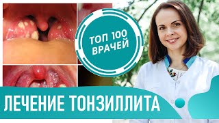 Лечение тонзиллита. Лечение ангины у взрослых и детей. Как лечить острый и хронический тонзиллит