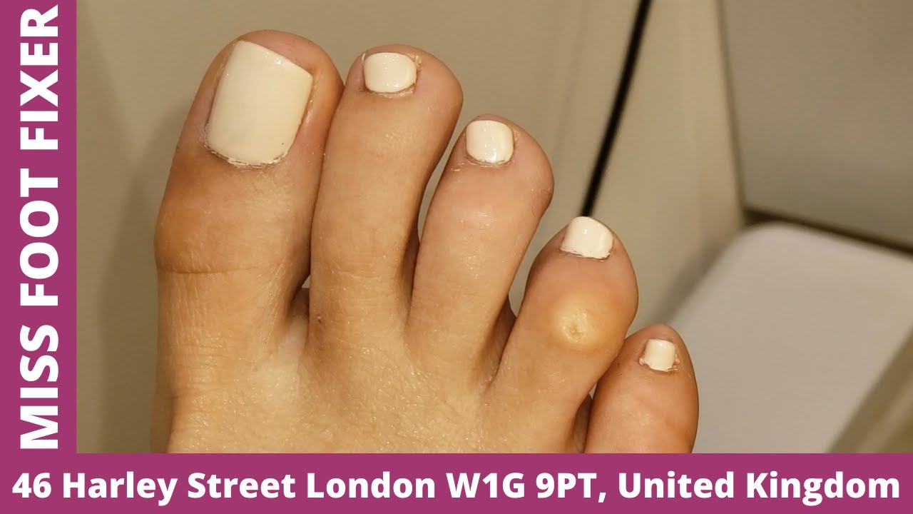 satisfying deep corn removal satisfying deep corn extraction removal