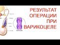 Результат операции при варикоцеле / Доктор Черепанов