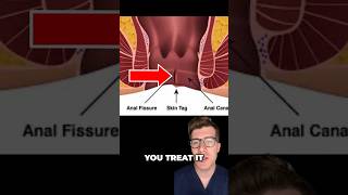 Sharp pain when you poo? Anal fissure explained…#shorts #health