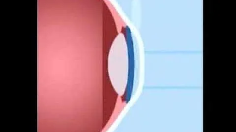 FREE LASIK Basics - Watch the LASIK Procedure in Video