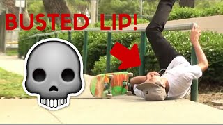 skateboarder busts open lip!