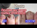 Итоги. Лечение ногтевого грибка ОГНЕВКОЙ. Настойка восковой моли. Наружное применение. Здоровье.