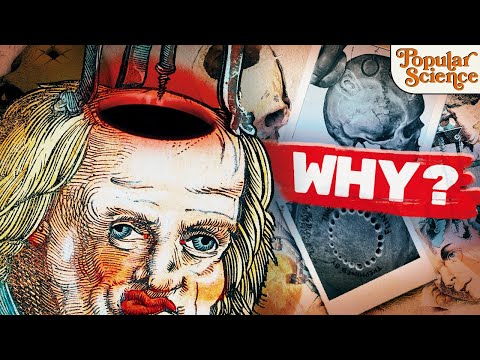 A history of trepanning: Why do we put holes in our skulls?
