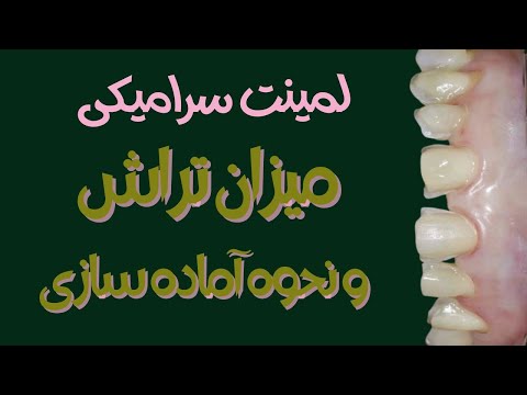 چه میزان تراش برای لمینت کردن دندانها لازمه لمینت کردن برای دندانها ضرر هم داره