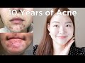 the best skincare for acne (no ad)