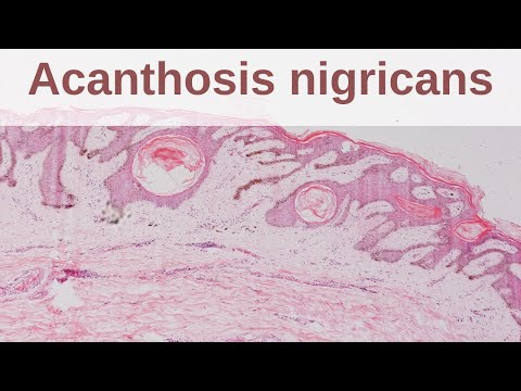 Acanthosis Nigricans - Pathology mini tutorial