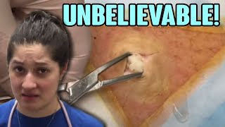 11 Year-Old Cyst - Gonzo Gets Sprayed! - Top Videos #35