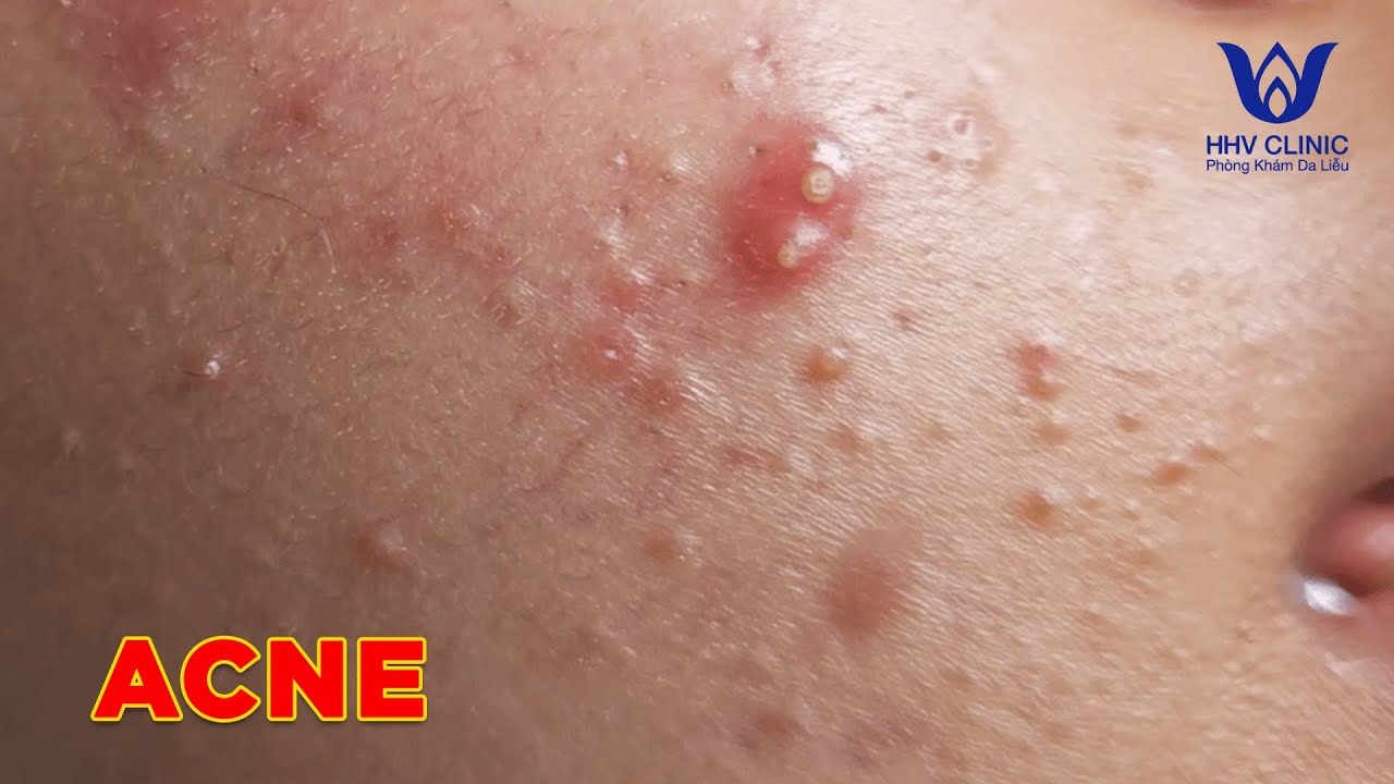 HHV Clinic | dothuhien | hienvanspa - Acne in  a young girl