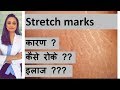 स्ट्रेच मार्क्स  का ईलाज |  Stretch marks in Hindi | त्वचा के डॉक्टर | डॉ आँचल पंत