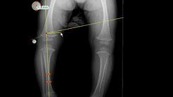 TraumaCad - Metaphyseal-Diaphyseal Angle