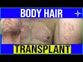 Body hair transplantation explained by experts