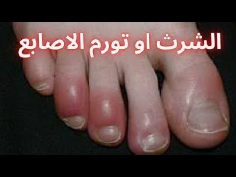 تورم أصابع اليدين والقدمين في الشتاء عضة البرد الشرث الشتاء البرد تورم اليدين القدمين