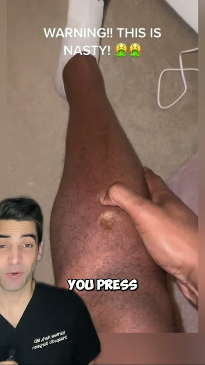 Edema
