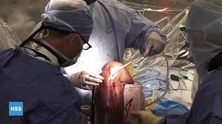 Femur and Tibia Derotational Osteotomies Live Surgery Dr. Rozbruch