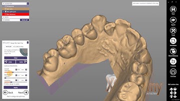 Want to Make a Bite Splint With Me