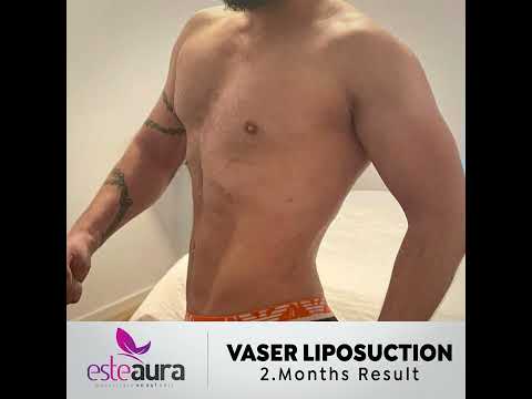 Liposuction  Result - Six Packs Hi-Def Liposuction Before / After Esteaura