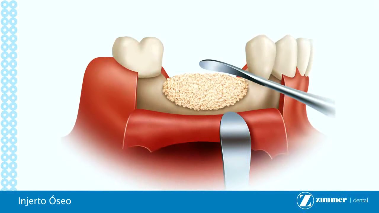 Capitulo7 Injertos óseos Zimmer Biomet YouTube