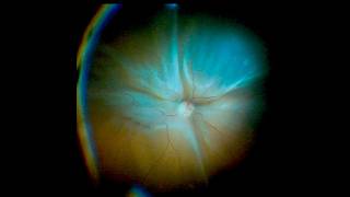 (3D) 🔴🎥 When the Retina Fights Back: Vitrectomy for Chronic Macula‑Off RD With Retinal Shortening