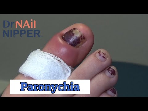 Dk Nail Nipper Jumamosi Maalum-Paronychia (2020)