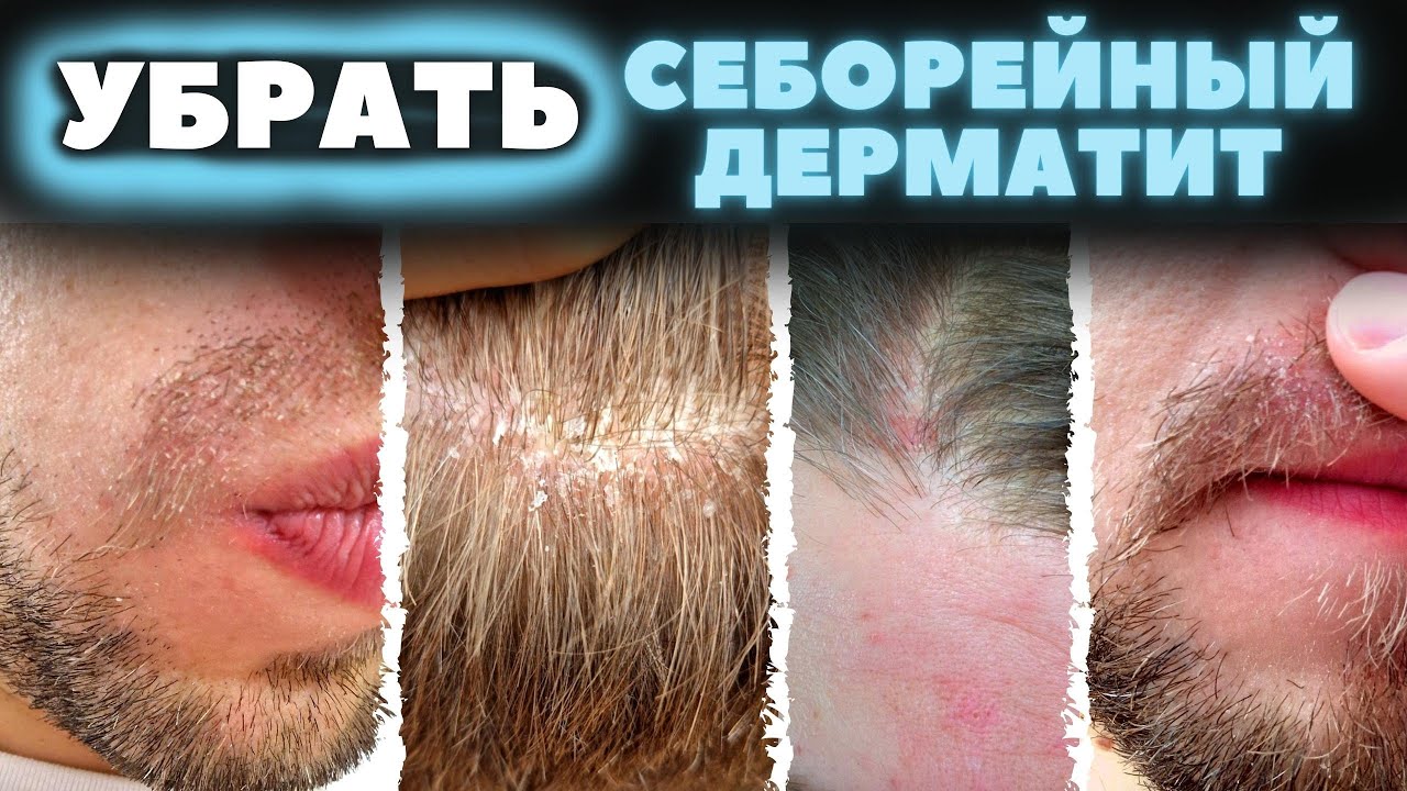 Перхоть прошла вместе с шелушениями на лице. Лечение себорейного ...