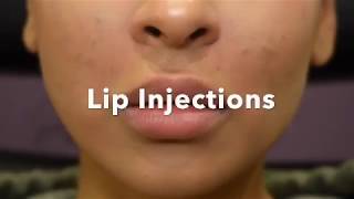 Lip Augmentation Up Close with Melanie Speed, RN