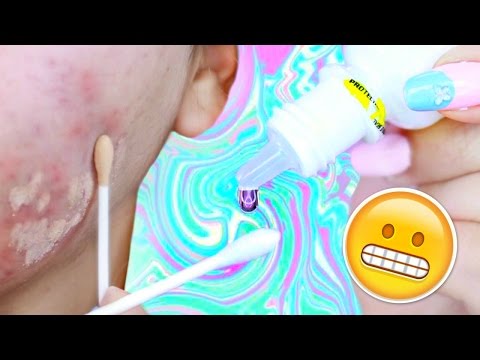  ACNE Hacks You MUST Try!