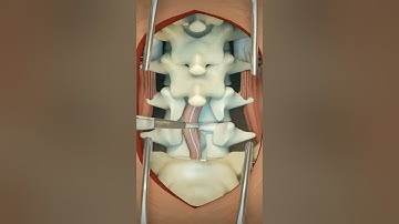 Lumbar Discectomy || 3D Animation #4k #animation #asmr