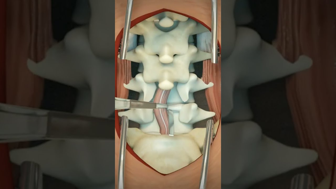Lumbar Discectomy 3D Animation 4k Asmr