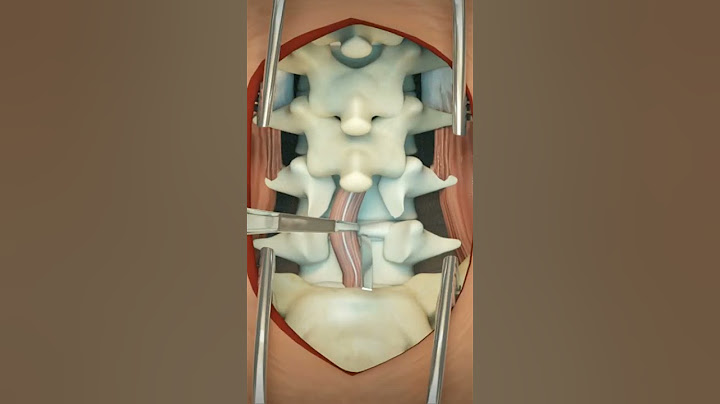 Lumbar Discectomy || 3D Animation #4k #animation #asmr