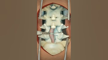 Lumbar Discectomy || 3D Animation #4k #animation #asmr