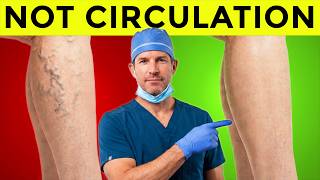 Varicose Veins Are NOT a Circulation Problem — This Is Why They Appear