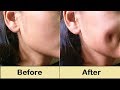 How To Get Dimples Fast & Naturally - Simple Facial Exercise to get Dimples without Surgery