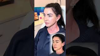 52 year old patient two months after a face lift, neck lift and CO2 laser