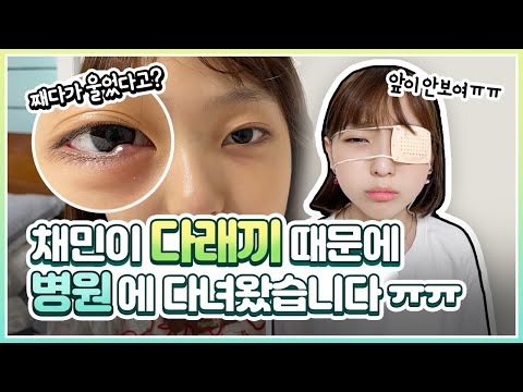 채민이 아파서 <strong>병원</strong> 다녀왔어요! ㅠㅠ 다래끼 고름 짜다가 울었습니다...  (<strong>증상</strong>, 치료, 약, 빨리 낫는 법 같이 알아봐요!)｜클레버TV