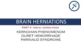 Brain Herniations 44- Uncal Herniationduret Hemorrhage, Kernohan Phenomenom & Parinaud Syndrome