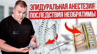 Опасные СИМПТОМЫ после эпидуральной анестезии. РЕАЛЬНАЯ причина боли в спине
