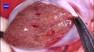 Micro TESE operation in Shaare Zedek medical center, Fertility and IVF unit