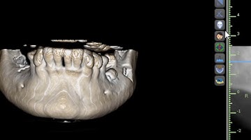 How to Improve Image Quality in Blue Sky Plan