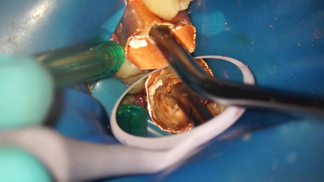 improving isolation using copper band and teflon for badly decayed