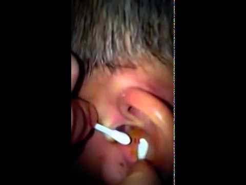 Popping a gross pimple in the ear kopia - YouTube