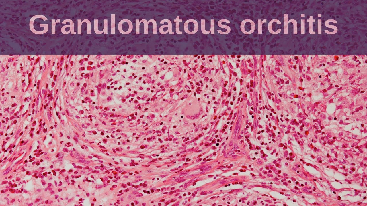 Gross Appearance Of Epididymo Orchitis
