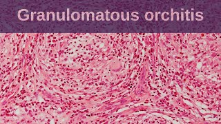 Idiopathic Granulomatous Orchitis - Pathology mini tutorial