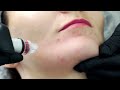 Hydra Facial Deep Pores Skin Cleansing Suction Islamabad Lahore Karachi Peshawar Pakistan